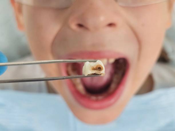 Best Emergency Wisdom Tooth Extraction in Tyndall Af, FL